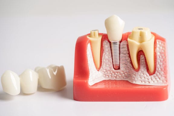Model of a dental implant in the mouth